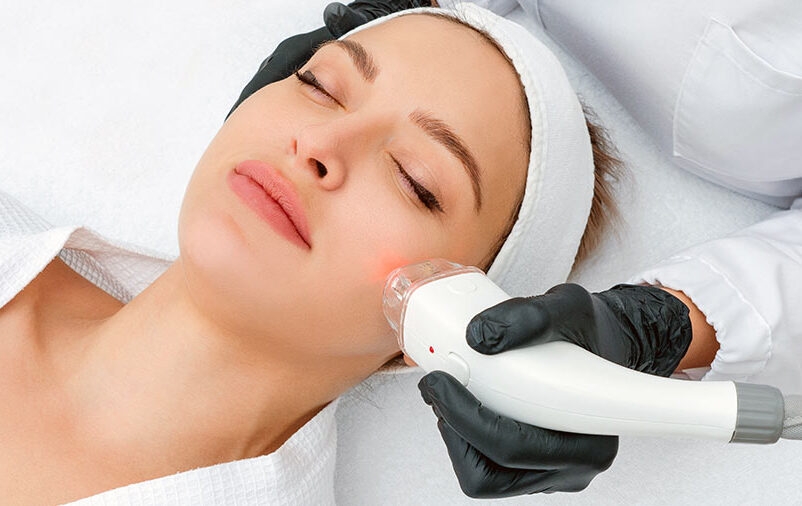 Mulher recebendo tratamento de laser Lavieen no rosto, aplicador emitindo luz vermelha sobre a pele, profissional com luvas pretas, ambiente clínico claro com toalhas brancas, fotografia de estética avançada