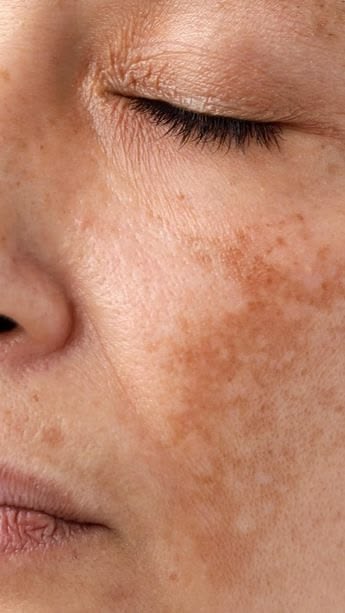 melasma