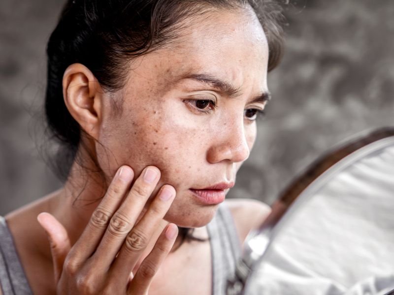 Mancha de melasma no rosto