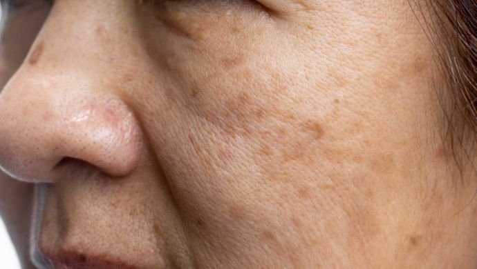 Melasma