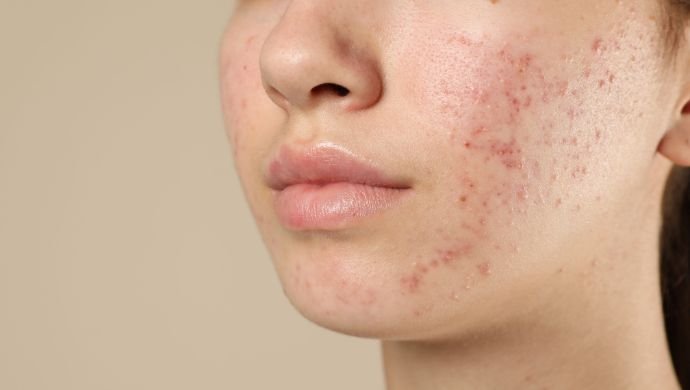 Acne