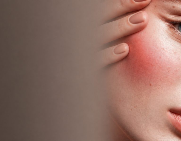 Tratamento facial estético para pele sensível e vermelhidão na Bellaris Clinic