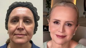 Antes e depois da paciente