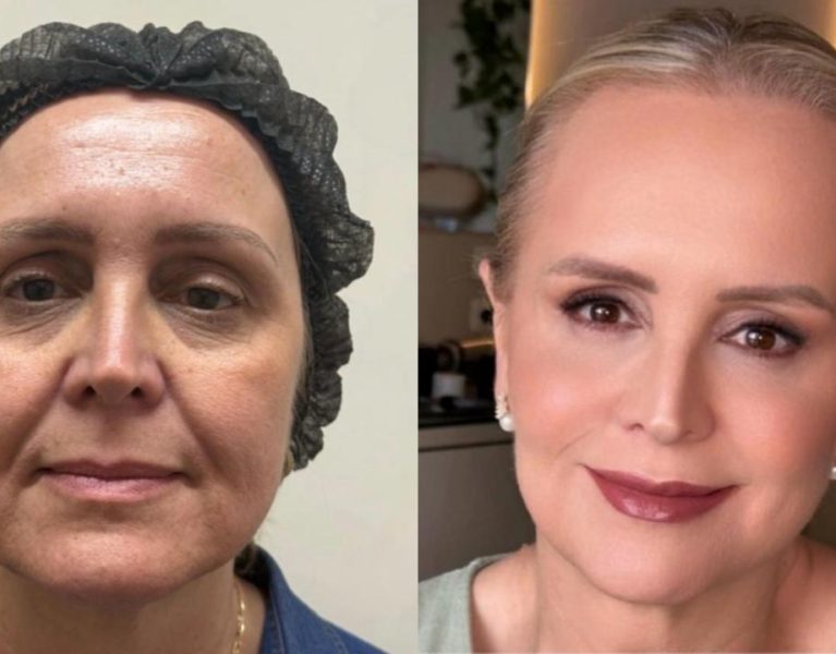 Antes e depois da paciente