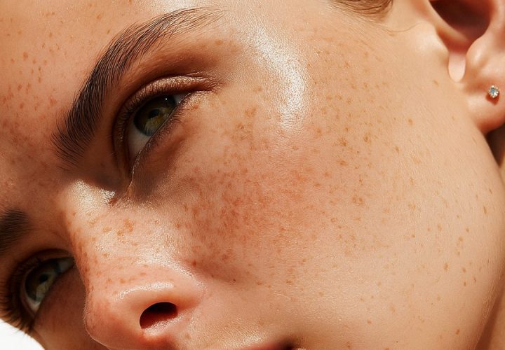 Rosto feminino em close com pele natural e manchas faciais leves, representando tratamentos para melasma e uniformização da pele na Bellaris Clinic.